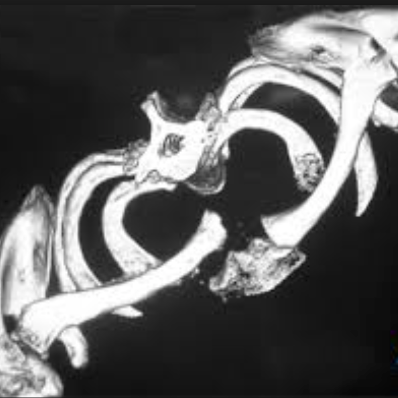 My biggest challenge: End to AFL dreams