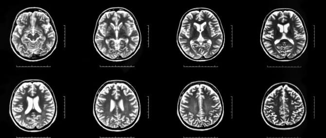 ECT: shock treatment given OK for young children post image